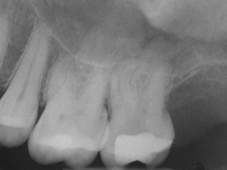 Ausgangsröntgenbild eines Zahnes vor Wurzelkanalbehandlung unter dem Operationsmikroskop