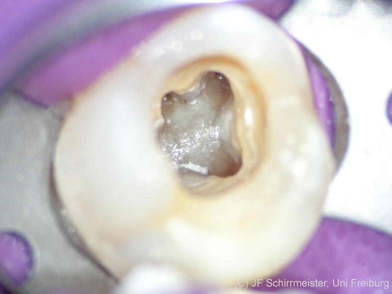 Blick durchs Operationsmikroskop in den Zahn, während der Wurzelbehandlung